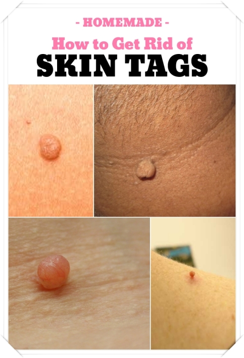 how-to-get-rid-of-skin-tags